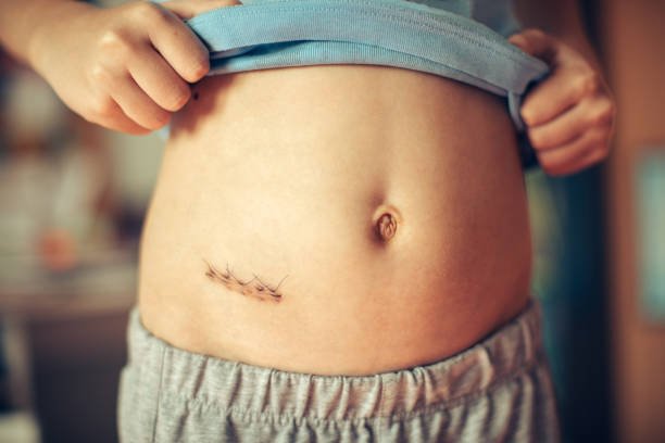 Best Doctor For Appendix In  New Delhi